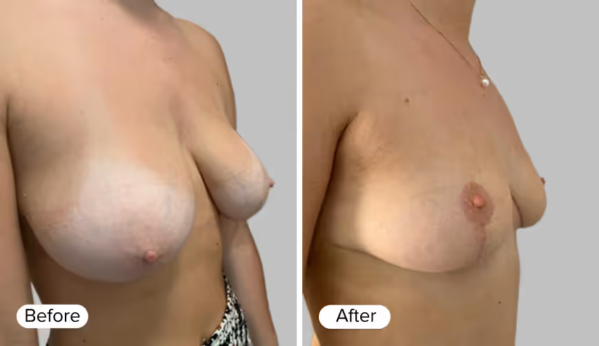 A side-by-side comparison showing two images of a woman's upper body. The left image shows the 'Before' view, with noticeable differences in breast shape. The right image shows the 'After' view, displaying a different breast contour.