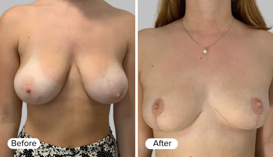 A side-by-side comparison of two images labeled 'Before' and 'After', showing the transformation in appearance of a woman’s chest.