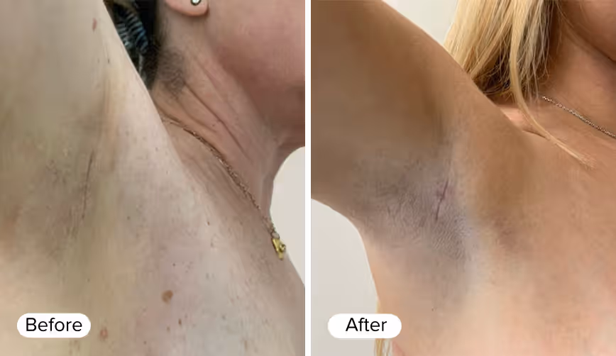 A side-by-side comparison of two underarms, labeled 'Before' on the left and 'After' on the right. The left side shows skin with visible hair follicles and slight discoloration, while the right side depicts smoother skin with minimal discoloration and a