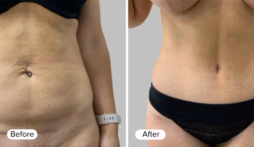 A side-by-side comparison of two images showing a woman's abdomen. The left image is labeled 'Before' and depicts loose skin and stretch marks, while the right image is labeled 'After' and shows a smoother abdomen with reduced visibility of stretch marks.