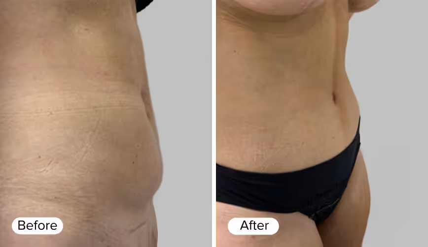 A side-by-side comparison of a person's abdomen showing 'Before' on the left and 'After' on the right. The 'Before' image displays visible skin texture and folds, while the 'After' image shows smoother skin.