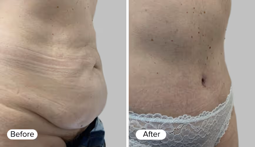 A side-by-side comparison image showing two torso views labeled 'Before' on the left and 'After' on the right. The 'Before' image displays loose skin with visible stretch marks, while the 'After' image shows a tighter appearance of the skin with a flatter