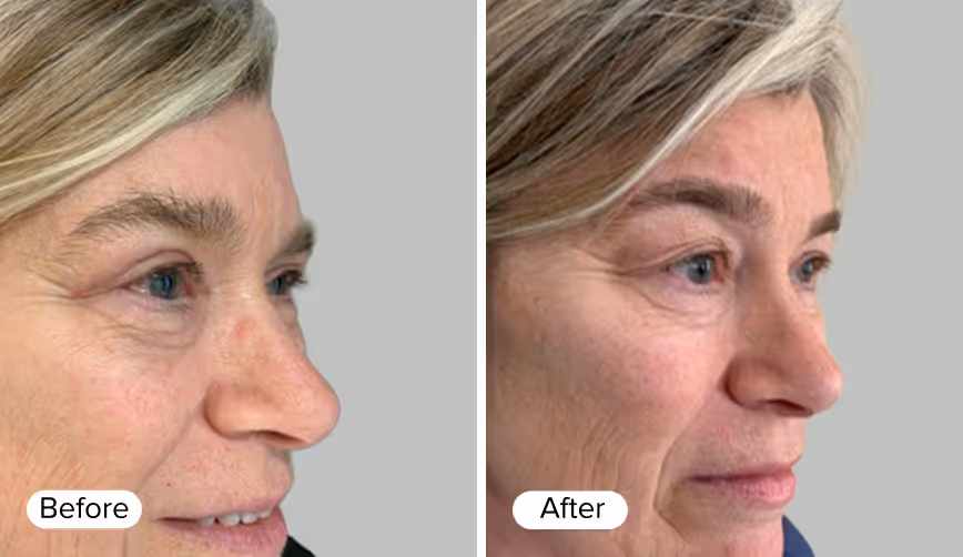 A side profile comparison of a woman's face divided into two sections labeled 'Before' and 'After'. The 'Before' section shows visible wrinkles and lines, while the 'After' section features smoother skin with reduced signs of aging.