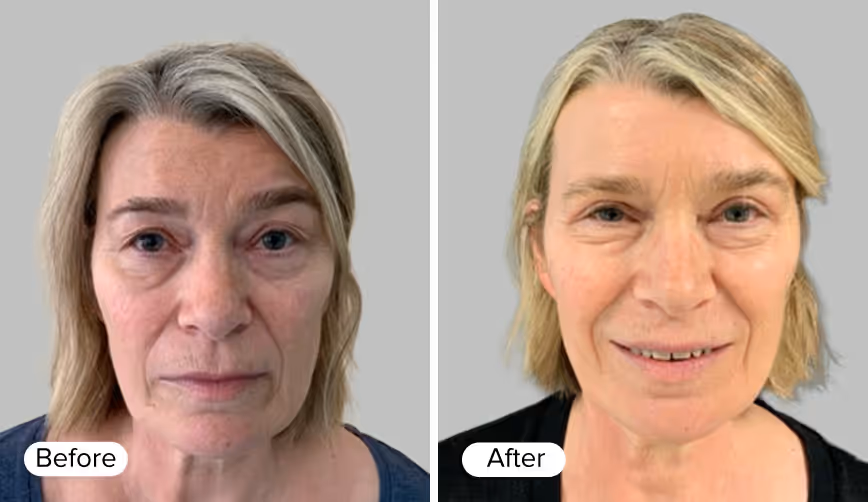 A split image showing two portraits of a woman. The left side is labeled 'Before' and features a woman with visible signs of aging and a neutral expression. The right side is labeled 'After' and displays the same woman with a rejuvenated appearance,
