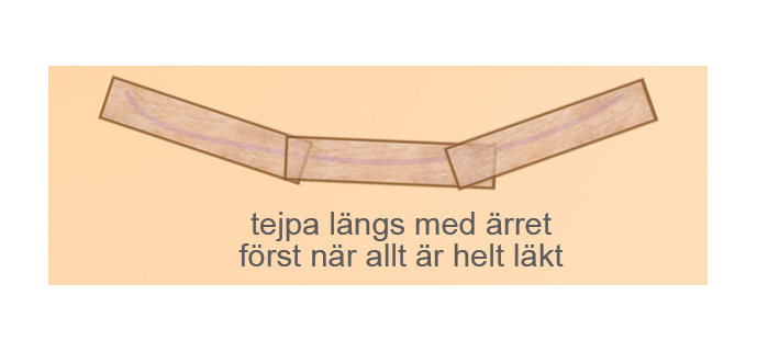 Hur ska jag tejpa mitt ärr?