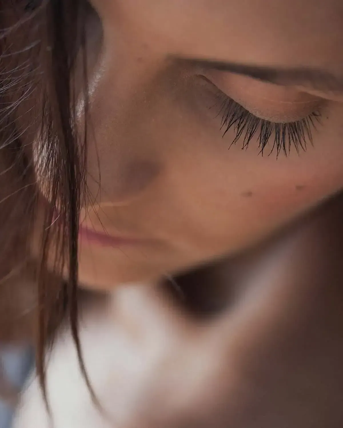 Recovery After Blepharoplasty
