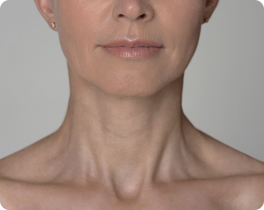 Rejuvenating the Neck: The Combined Face and Neck Lift