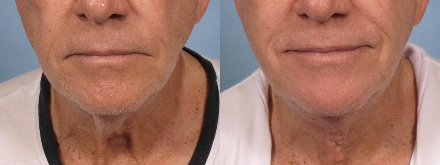 Neck Lift w/Liposuction before and after, case 187