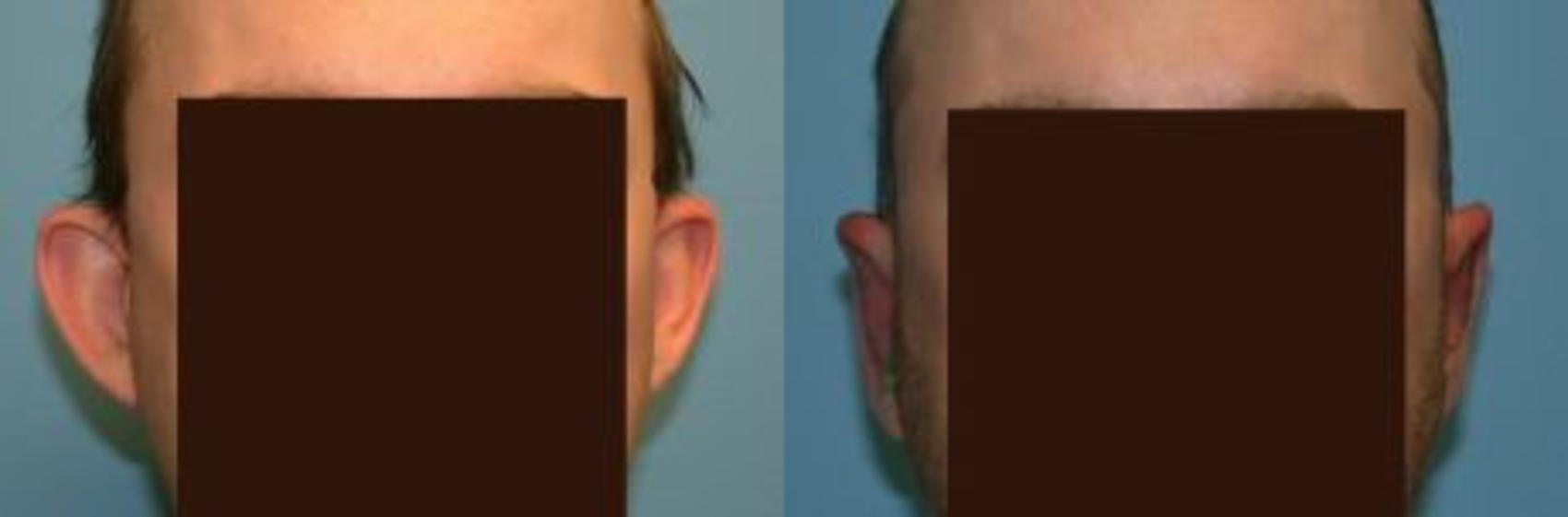 Ear Shaping/Otoplasty before and after, case 12