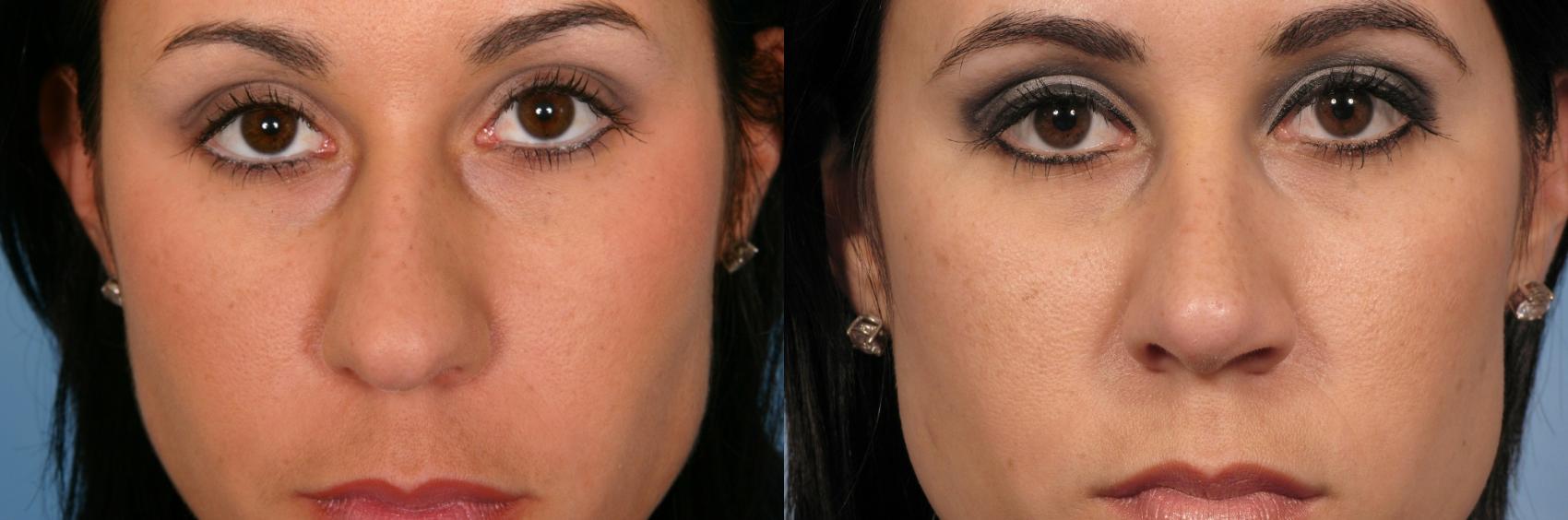 Rhinoplasty before and after, case 127